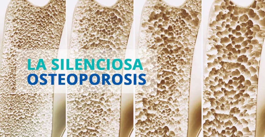 Osteoporosis ¿Quién puede padecerla? Todo el Mundo